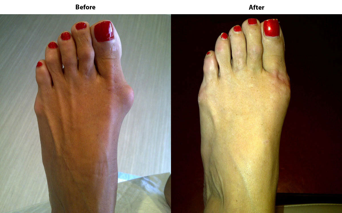 Martin Brain D.P.M Podiatrist - Before & After Bunion Surgery.