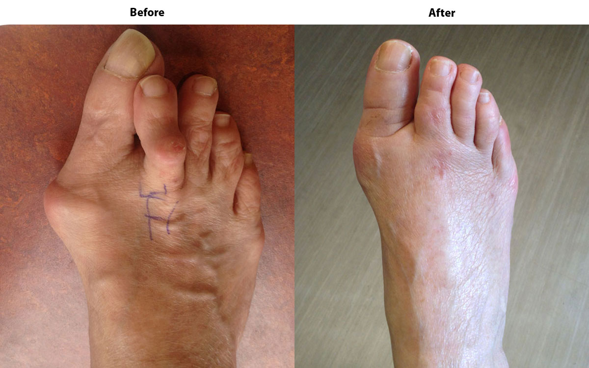 What should you expect after hammertoe surgery?