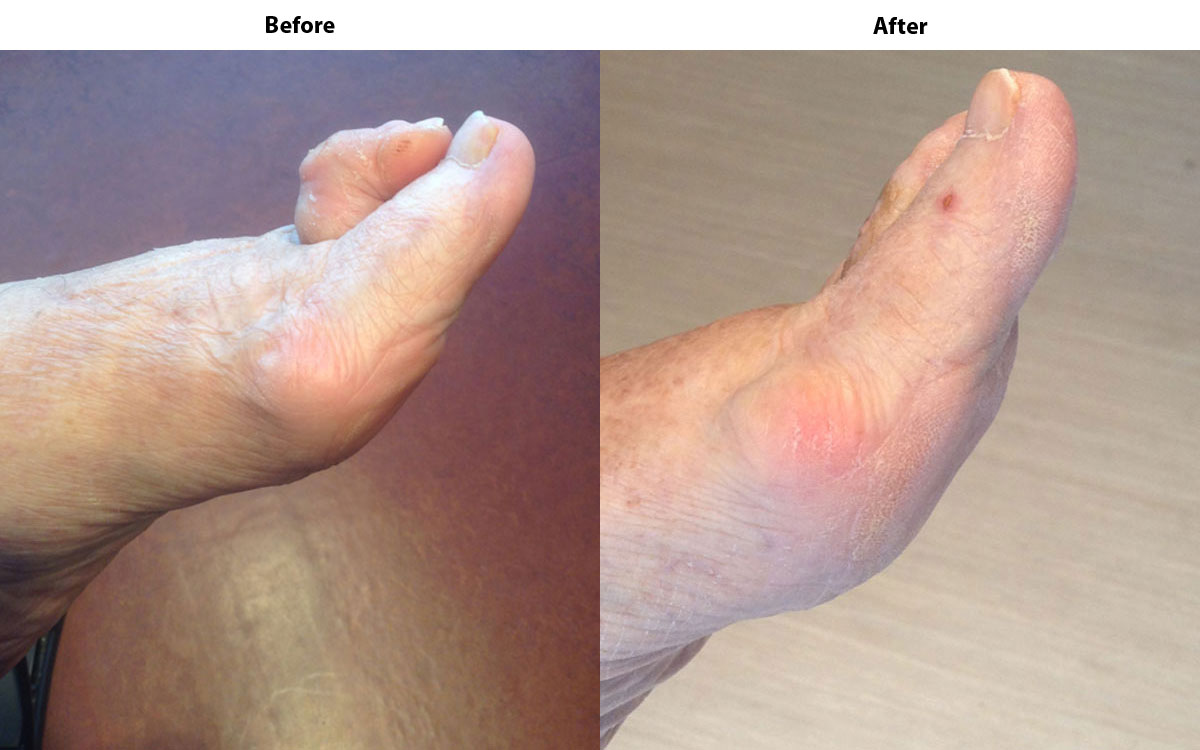 What should you expect after hammertoe surgery?